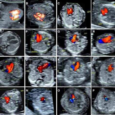 Understanding how 4 abnormal ultrasound findings .